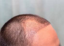 Haartransplantation Türkei Kosten: Finding the Right Price for Your Hair Goals